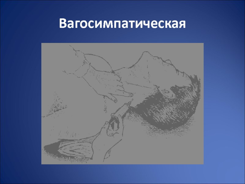 Вагосимпатическая